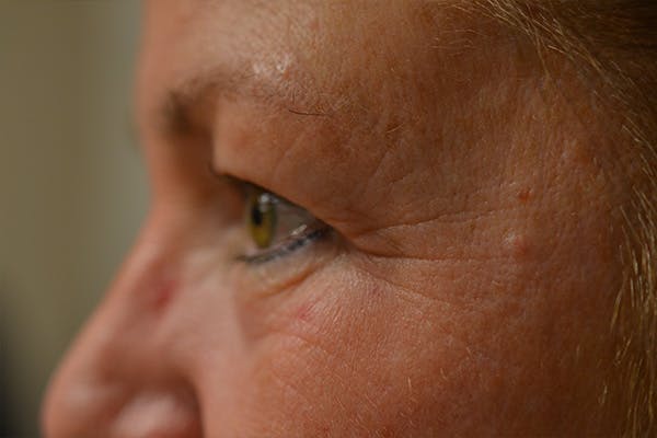 Eyelid Surgery Before & After Gallery - Patient 942366 - Image 9