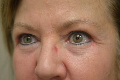 Eyelid Surgery Before & After Gallery - Patient 942366 - Image 8
