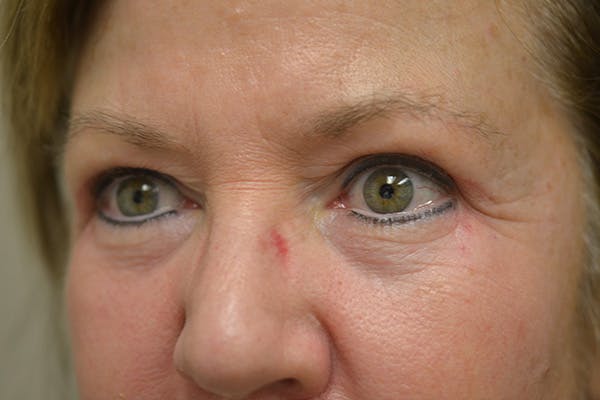 Eyelid Surgery Before & After Gallery - Patient 942366 - Image 8