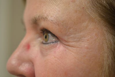 Eyelid Surgery Before & After Gallery - Patient 942366 - Image 10