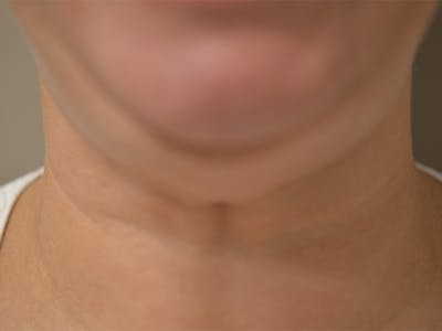 Chin Tuck Before & After Gallery - Patient 511294 - Image 1