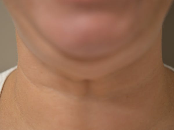 Chin Tuck Before & After Gallery - Patient 511294 - Image 1