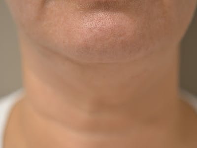 Chin Tuck Before & After Gallery - Patient 511294 - Image 2