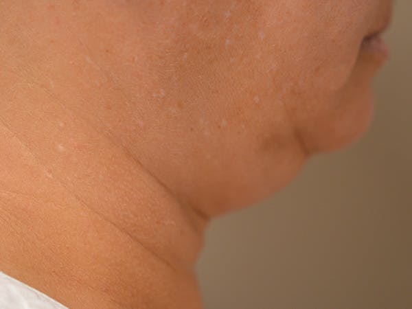 Chin Tuck Before & After Gallery - Patient 511294 - Image 3