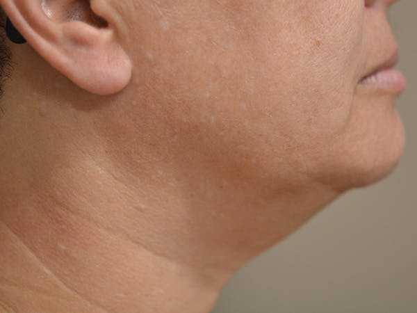 Chin Tuck Before & After Gallery - Patient 511294 - Image 4