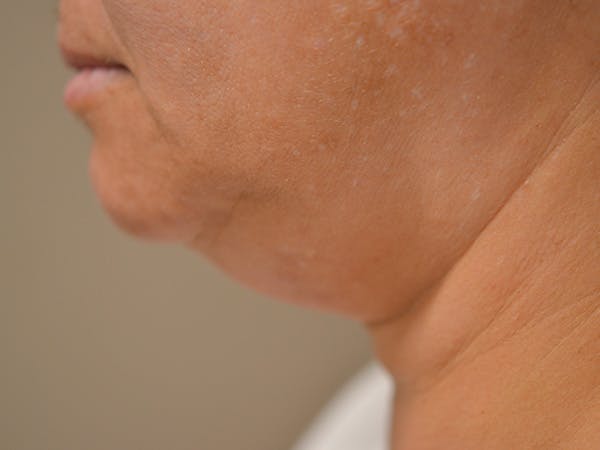 Chin Tuck Before & After Gallery - Patient 511294 - Image 5