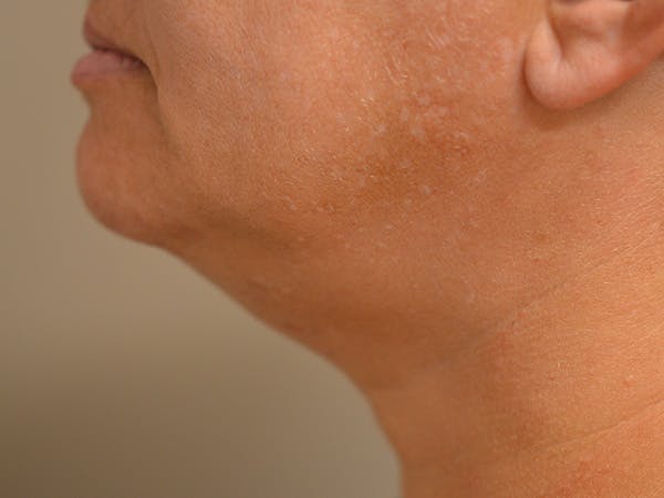 Chin Tuck Before & After Gallery - Patient 511294 - Image 6