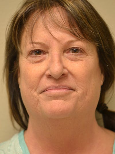 Facelift Before & After Gallery - Patient 365410 - Image 1