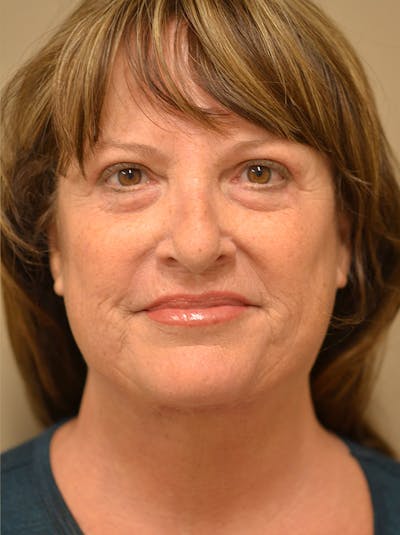 Facelift Before & After Gallery - Patient 365410 - Image 2