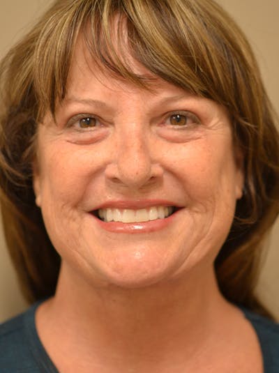 Facelift Before & After Gallery - Patient 365410 - Image 4