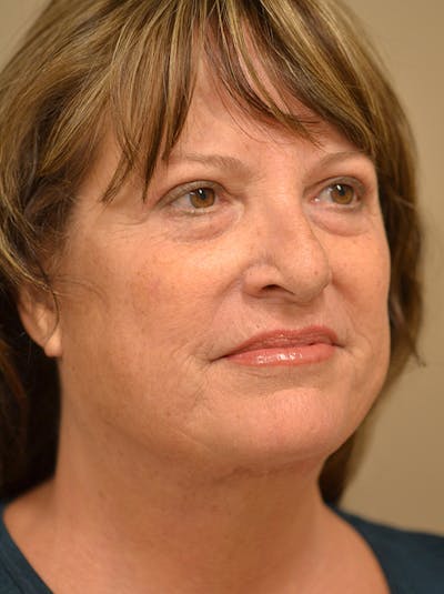 Facelift Before & After Gallery - Patient 365410 - Image 6