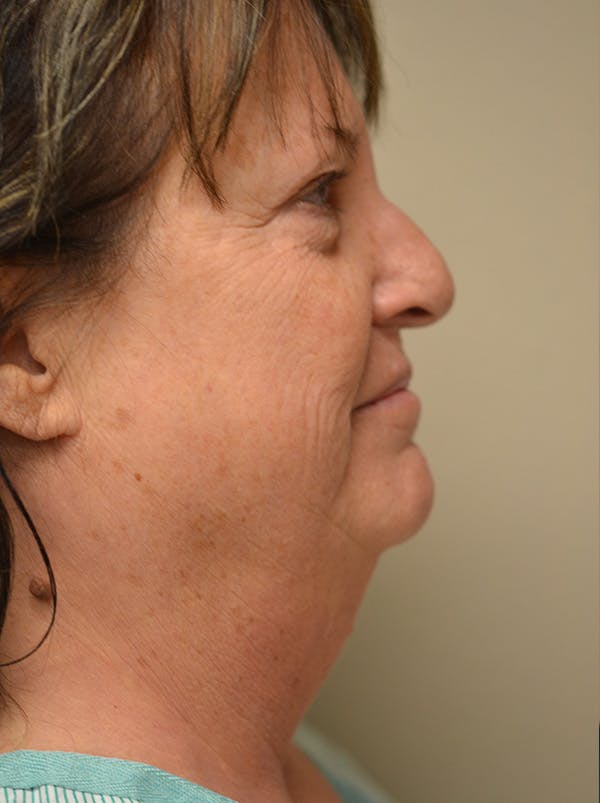 Facelift Before & After Gallery - Patient 365410 - Image 7