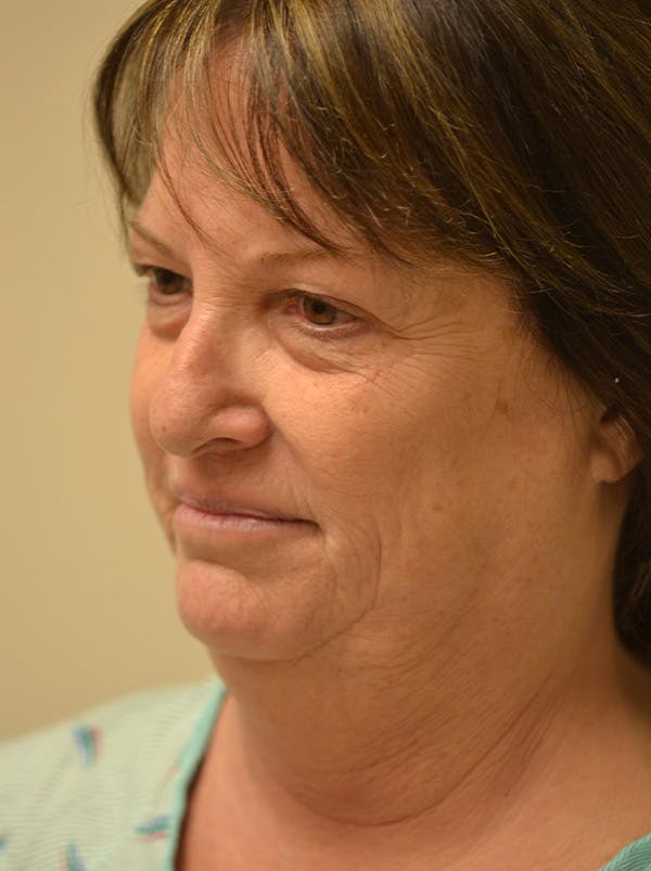 Facelift Before & After Gallery - Patient 365410 - Image 9