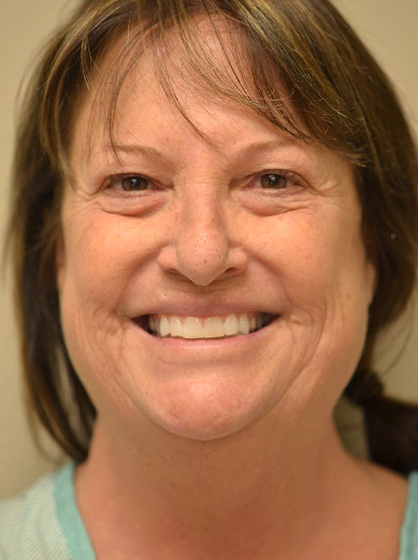 Facelift Before & After Gallery - Patient 365410 - Image 3