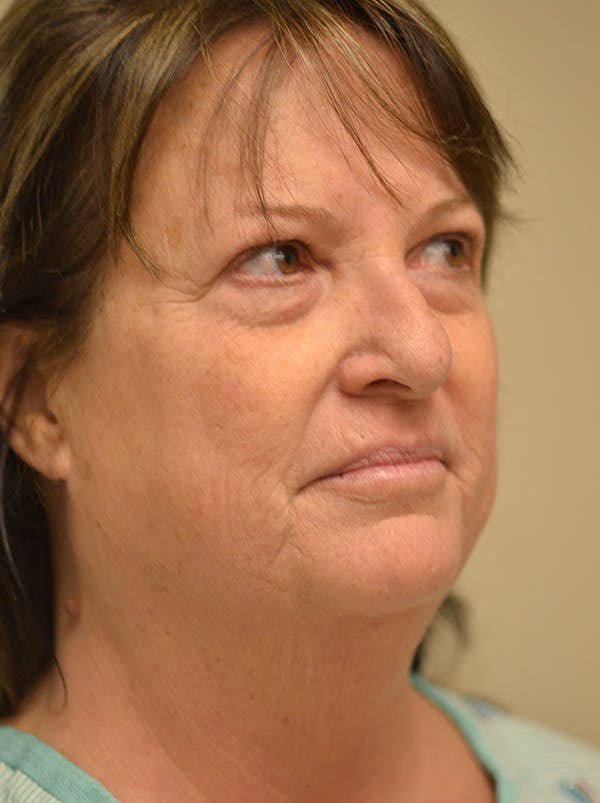 Facelift Before & After Gallery - Patient 365410 - Image 5