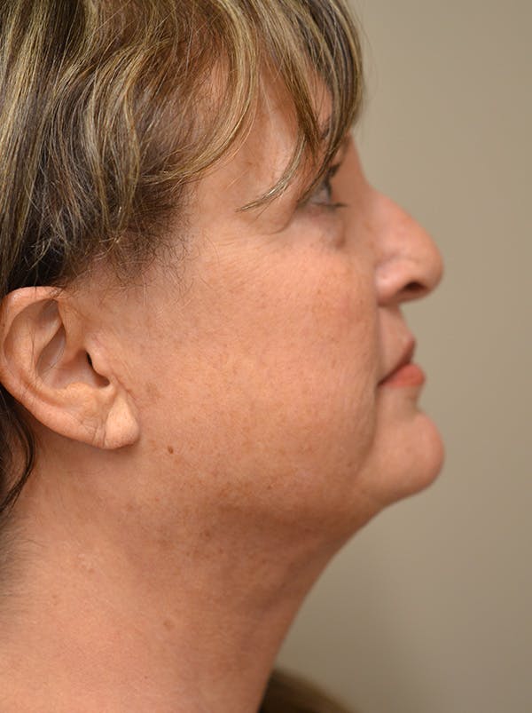 Facelift Before & After Gallery - Patient 365410 - Image 8