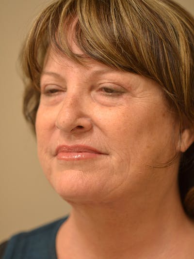 Facelift Before & After Gallery - Patient 365410 - Image 10