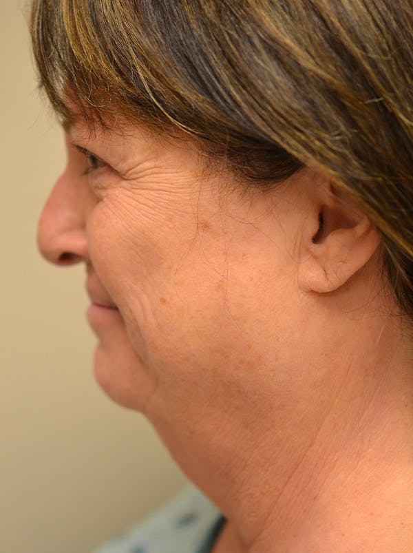 Facelift Before & After Gallery - Patient 365410 - Image 11