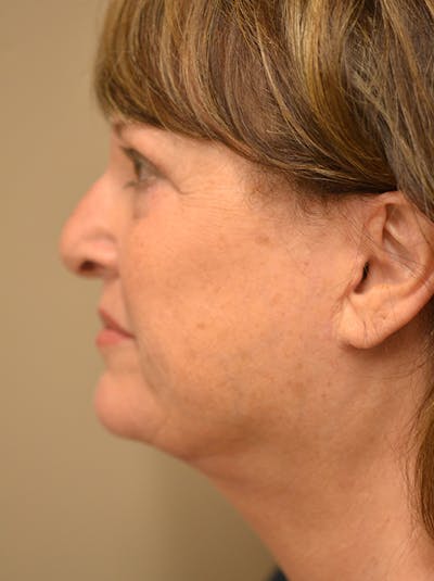 Facelift Before & After Gallery - Patient 365410 - Image 12