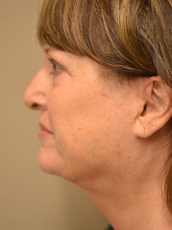 Facelift Before & After Gallery - Patient 365410 - Image 12