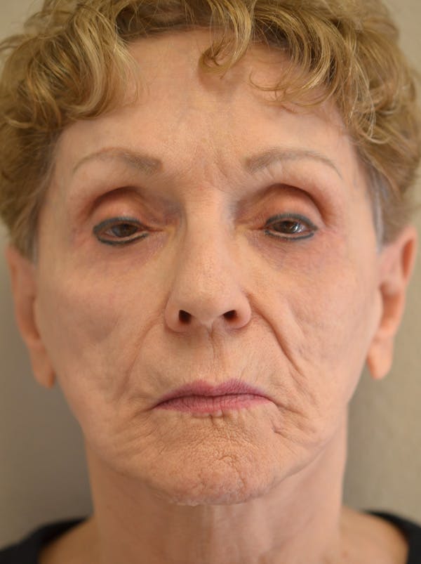Smile Line Surgery Before & After Gallery - Patient 999272 - Image 1