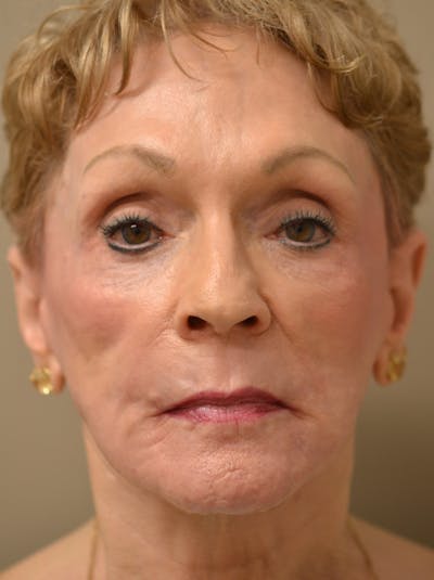 Smile Line Surgery Before & After Gallery - Patient 999272 - Image 2