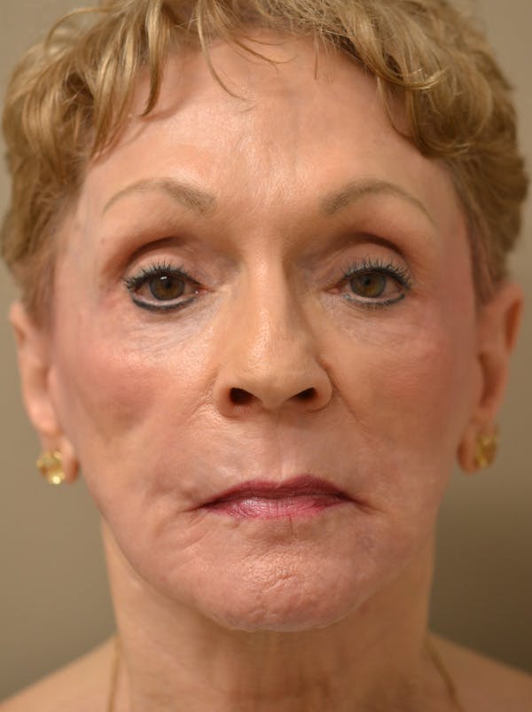 Smile Line Surgery Before & After Gallery - Patient 999272 - Image 2