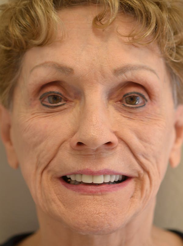 Smile Line Surgery Before & After Gallery - Patient 999272 - Image 3