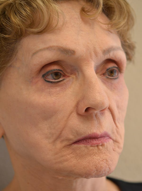 Smile Line Surgery Before & After Gallery - Patient 999272 - Image 5