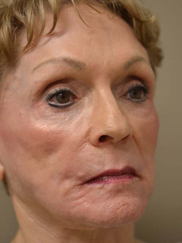 Smile Line Surgery Before & After Gallery - Patient 999272 - Image 6