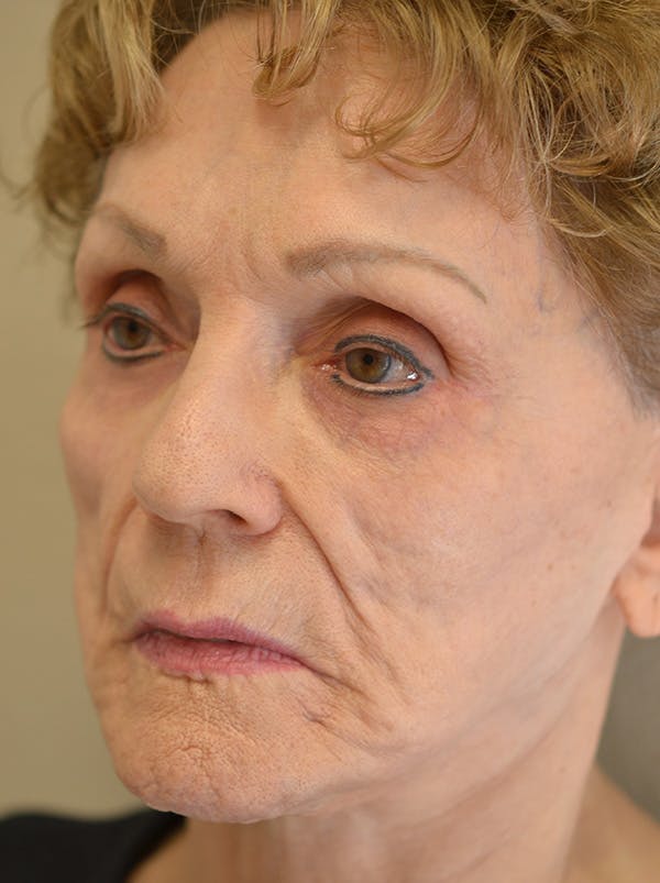Smile Line Surgery Before & After Gallery - Patient 999272 - Image 7
