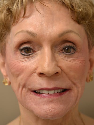 Smile Line Surgery Before & After Gallery - Patient 999272 - Image 4