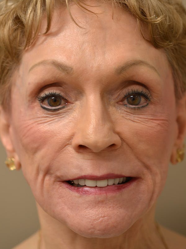Smile Line Surgery Before & After Gallery - Patient 999272 - Image 4
