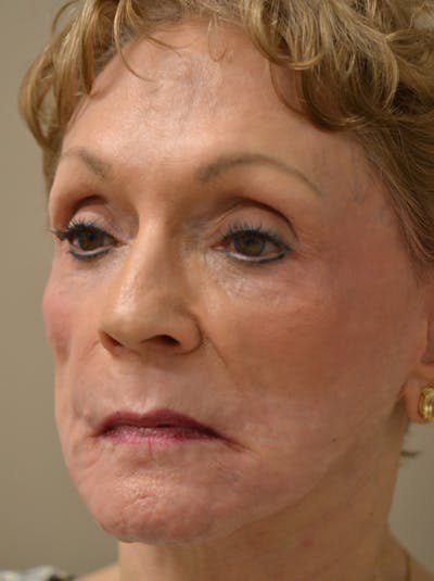 Smile Line Surgery Before & After Gallery - Patient 999272 - Image 8
