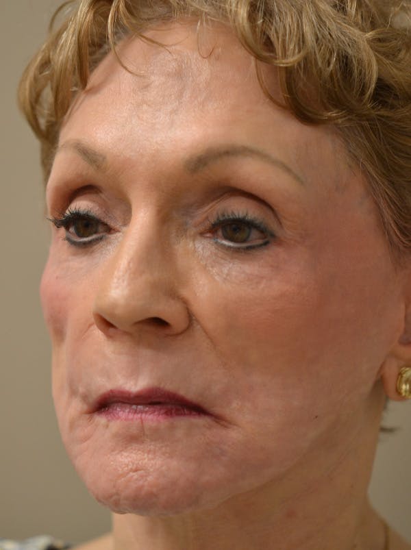 Smile Line Surgery Before & After Gallery - Patient 999272 - Image 8