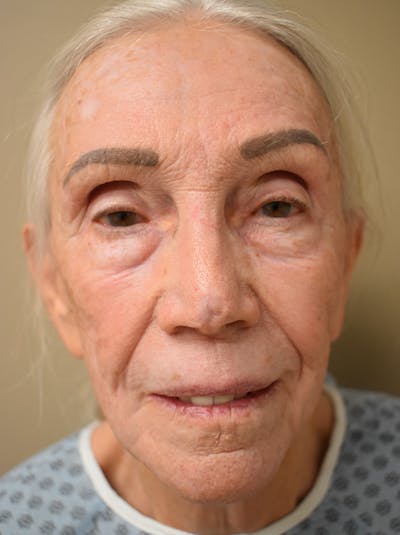Facelift Before & After Gallery - Patient 211713 - Image 1