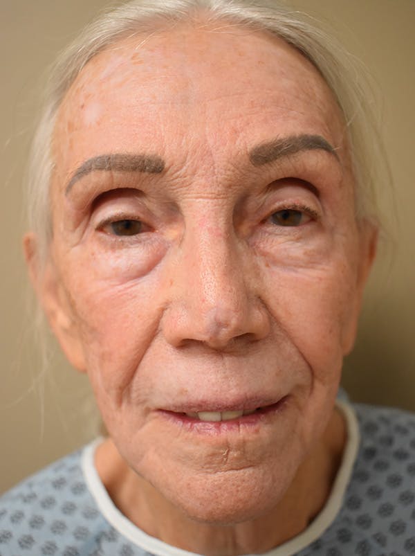 Facelift Before & After Gallery - Patient 211713 - Image 1