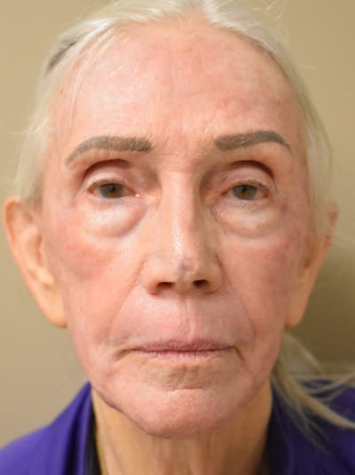 Facelift Before & After Gallery - Patient 211713 - Image 2