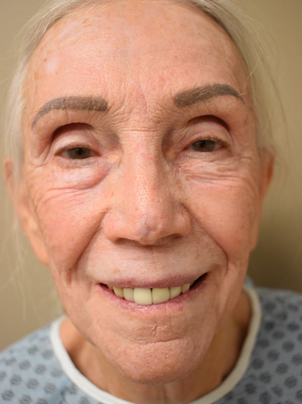 Facelift Before & After Gallery - Patient 211713 - Image 3