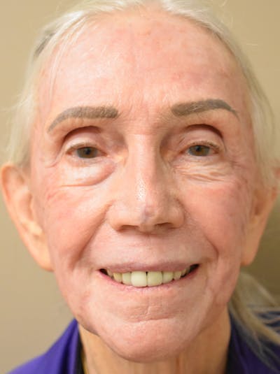 Facelift Before & After Gallery - Patient 211713 - Image 4