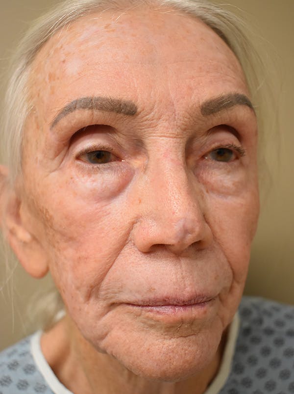 Facelift Before & After Gallery - Patient 211713 - Image 5
