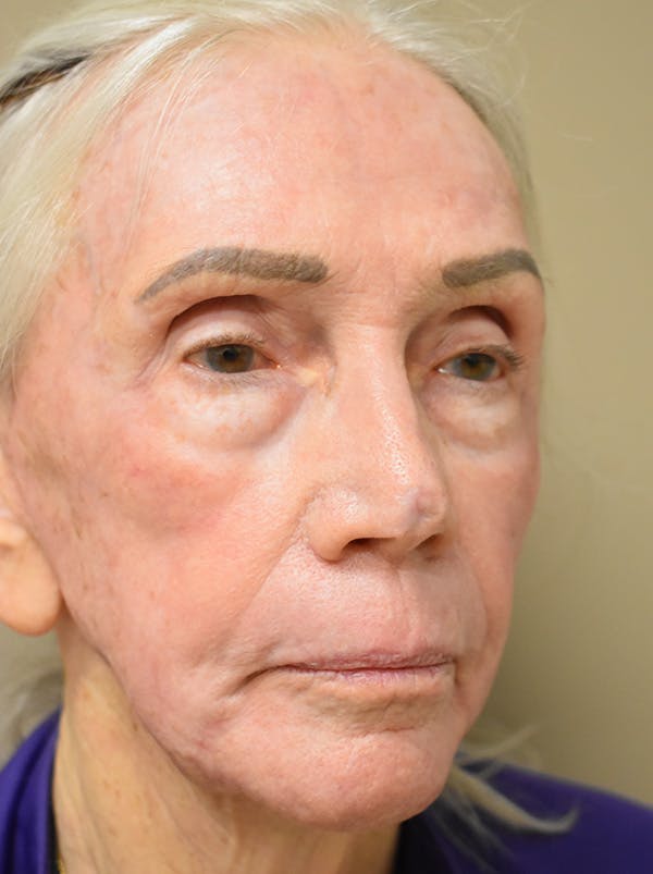 Facelift Before & After Gallery - Patient 211713 - Image 6