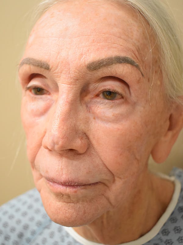 Facelift Before & After Gallery - Patient 211713 - Image 7