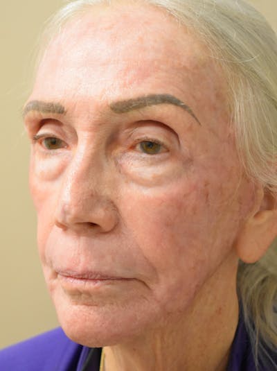 Facelift Before & After Gallery - Patient 211713 - Image 8