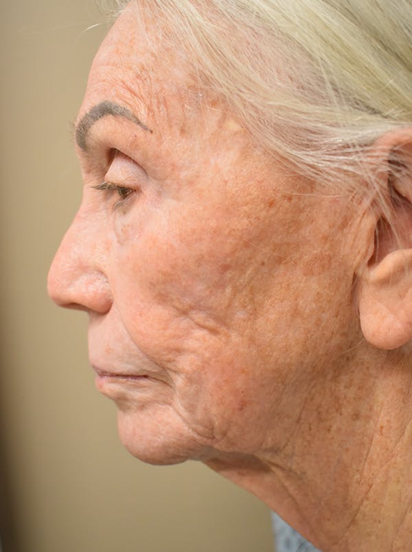 Facelift Before & After Gallery - Patient 211713 - Image 9