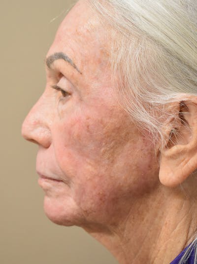 Facelift Before & After Gallery - Patient 211713 - Image 10