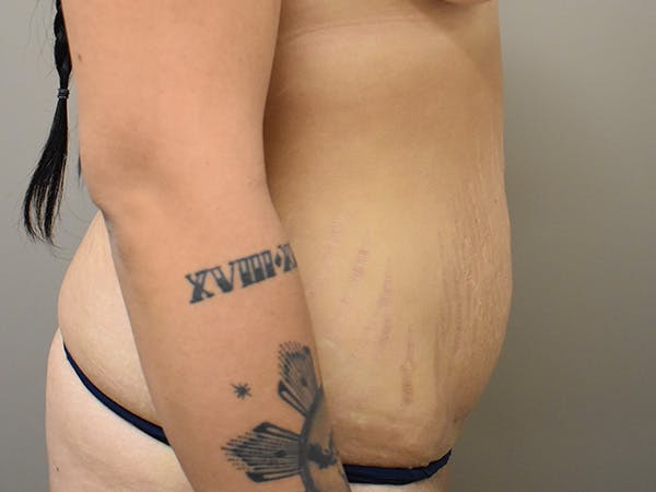 Tummy Tuck Before & After Gallery - Patient 111684 - Image 5
