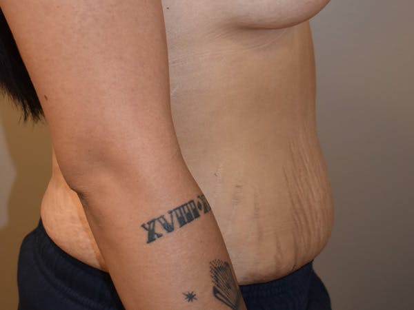 Tummy Tuck Before & After Gallery - Patient 111684 - Image 6