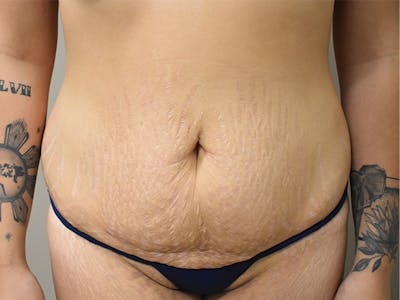 Tummy Tuck Before & After Gallery - Patient 111684 - Image 1