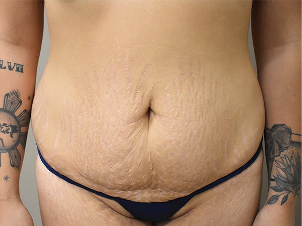 Tummy Tuck Before & After Gallery - Patient 111684 - Image 1